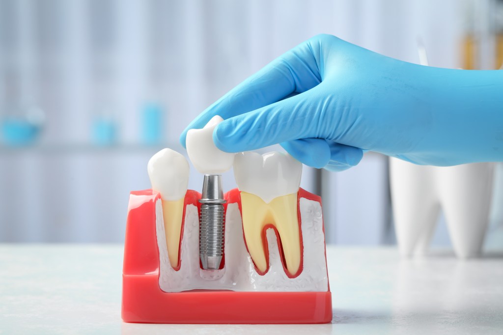 What If I’ve Been Told I Don’t Have Enough Jawbone for Dental Implants?